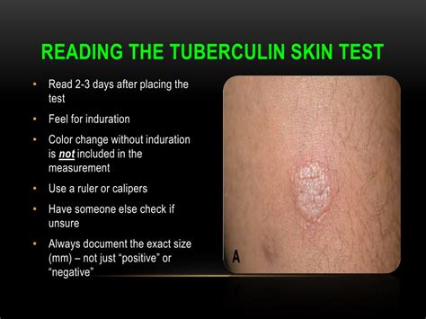 mt test positive images|TB Skin Test .